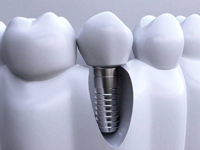 做種植牙全程需要多長時(shí)間呢?