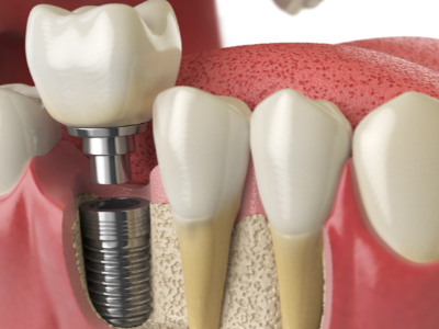 選擇種植牙后要做哪些日常維護(hù)？