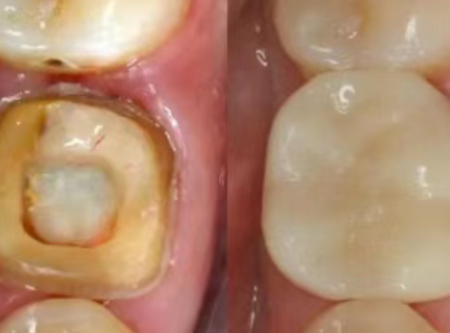 根管治療（抽神經(jīng)）后，為什么一定要做牙冠？