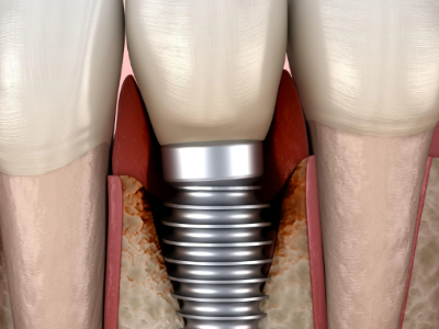 種植牙的術(shù)前準備有哪些？