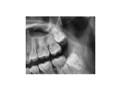 既然「智齒」不宜久留，為什么不能一次性拔掉？