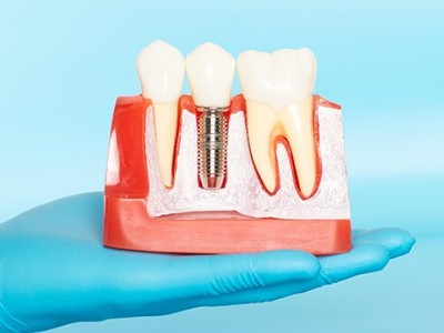 種牙VS鑲牙，你適合哪種?
