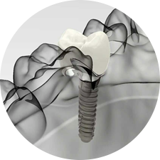術(shù)前研究、模擬提升種植成功率