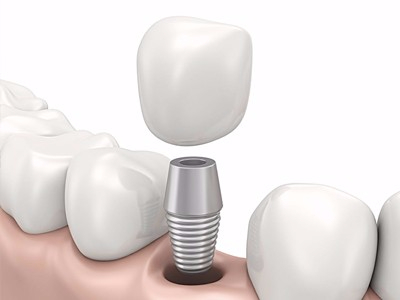 在承德哪家口腔醫(yī)院口腔種植齒好一點，惟德口腔醫(yī)院值得您的選擇