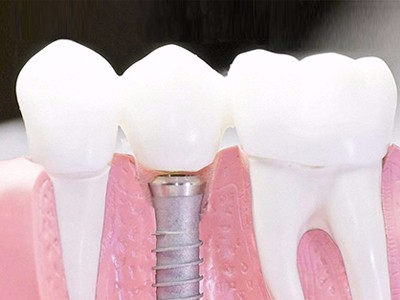 在承德口腔種植齒需要多少錢？惟德口腔一一為您道來