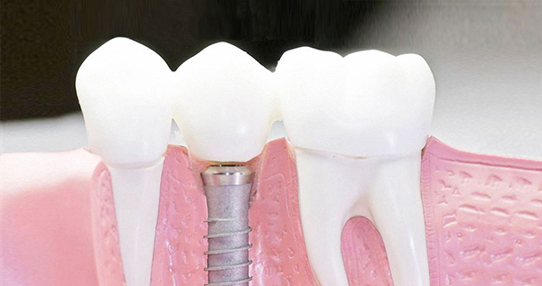 在承德口腔種植牙齒需要多少錢？惟德口腔一一為您道來(lái)