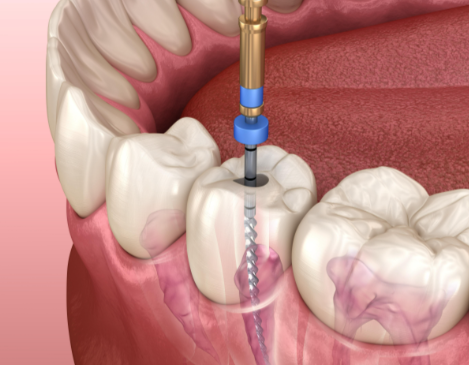 根管治療后的注意事項(xiàng)有哪些？